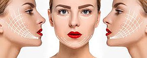 Fadenlifting Gesichtsregionen