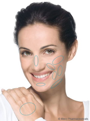 Behandlungsareale Radiesse