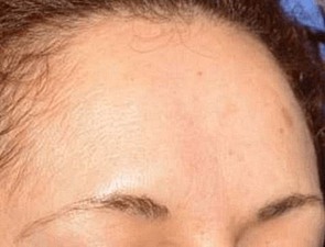 Behandlungsergebnis Stirn nachher