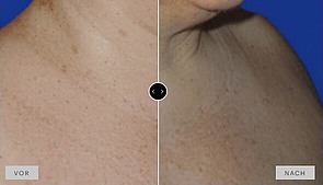 Ergebnis MesoPeel Melanoplus