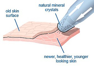 Wirkweise Microdermabrasion