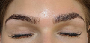 Wirkweise Brow-Lift
