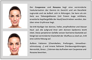 Hautproblem Couperose und Rosezea