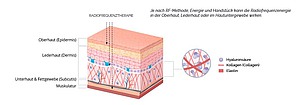 Eindringtiefe der Radiofrequenz in die Haut