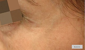 Behandlungsergebnis Krähenfüsse nachher