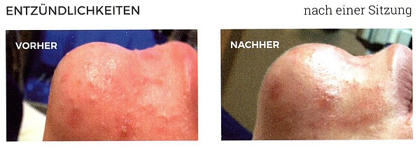 Entzündlichkeiten vorher-nachher