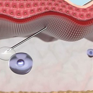 Wirkungsweise LINeRASE