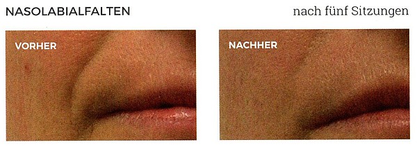Nasolabialfalten vorher-nachher