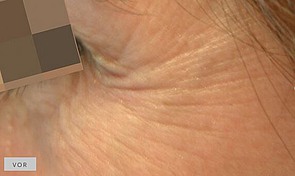 Behandlungsergebnis Krähenfüsse vorher