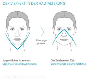 Behandlungsvorteile Radiesse