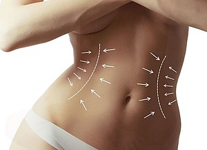 Bauchareale für CelsiaShape-Behandlung