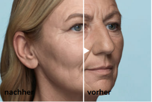 Beschreibung Wirkstoff Radiesse