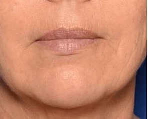 Behandlungsergebnis Mundfalten nachher