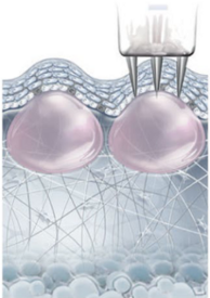 Behandlungsablauf BeautyfEYE Step 2