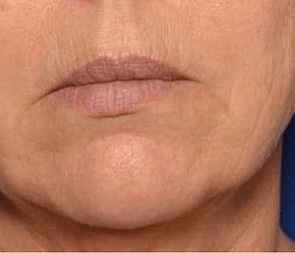 Behandlungsergebnis Mundfalten vorher