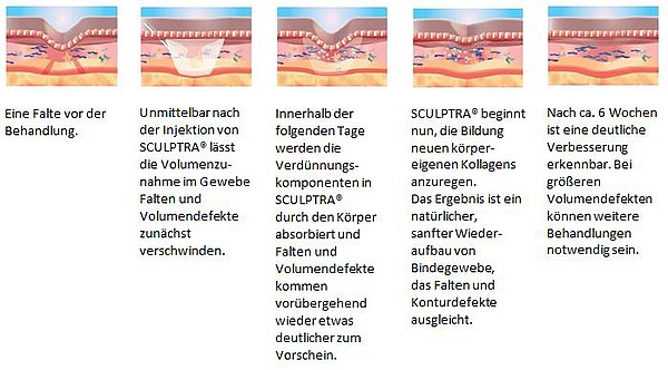 Wirkmechanismus Sculptra