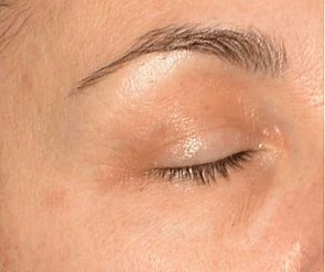 Behandlungsergebnis Krähenfüsse - nachher