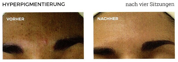 Hyperpigmentierung vorher-nachher