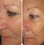 THESERA L - vorher l nachher