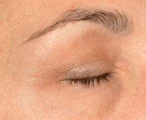 Behandlungsergebnis Krähenfüsse - vorher