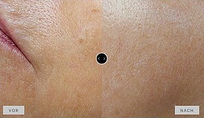 Ergebnis MesoPeel phenTCA