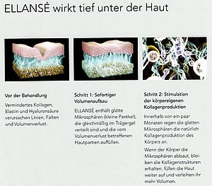 Wirkweise von ELLANSÉ®