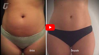 YouTube-Video zu Adipologie-Behandlung