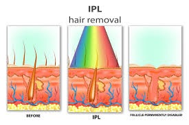 IPL Dauerhafte Haarentfernung