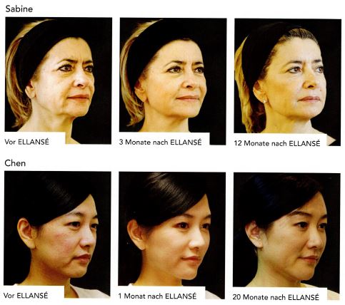 Erfolge ELLANSÉ®-Behandlung