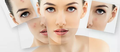 Microneedling-Behandlung